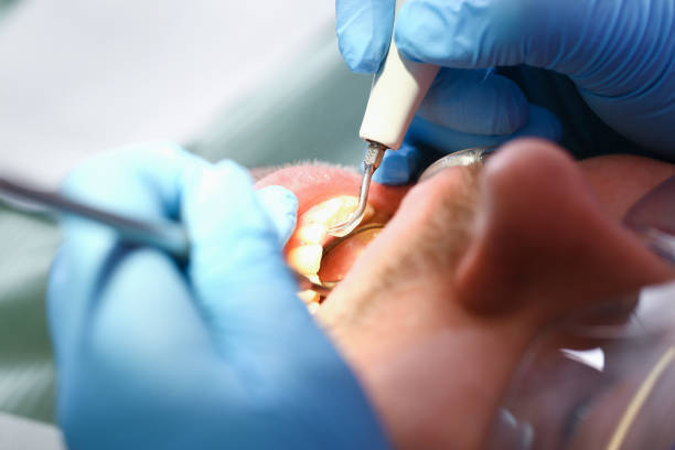 Best Emergency Tooth Extraction in Rapid Valley, SD
